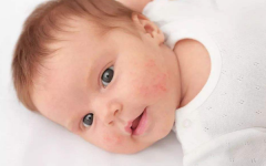 小宝宝患有湿疹，宝宝饮食和母乳妈妈饮食，应该注意这些